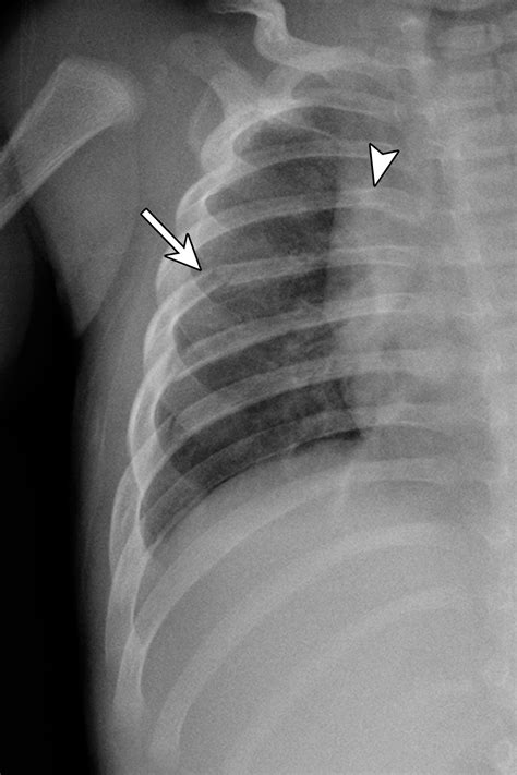 4 is a billablespecific ICD-10-CM code that can be used to indicate a diagnosis for reimbursement purposes. . Multiple rib fractures icd 10